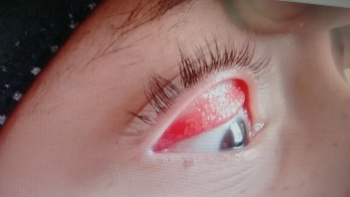 Tracoma nas escolas